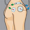 Placement electrode compex deltoide epaule