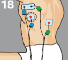 Placement electrode compex dos dorsaux dorsal