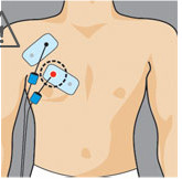 Placement electrode compex pectoraux pecs